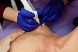 Leia mais sobre o artigo Justiça Federal condena esteticista a interromper procedimentos de eletrocauterização de lesões cutâneas (05/02/2026)